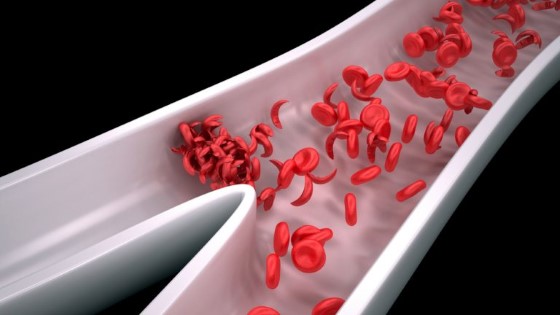 Srpkovitá anemie je jedním z mnoha typů tohoto onemocnění, je však jedna z těch rizikovějších, jelikož vlivem abnormálního tvaru červených krvinek (srpků) může dojít k zablokování toku krve